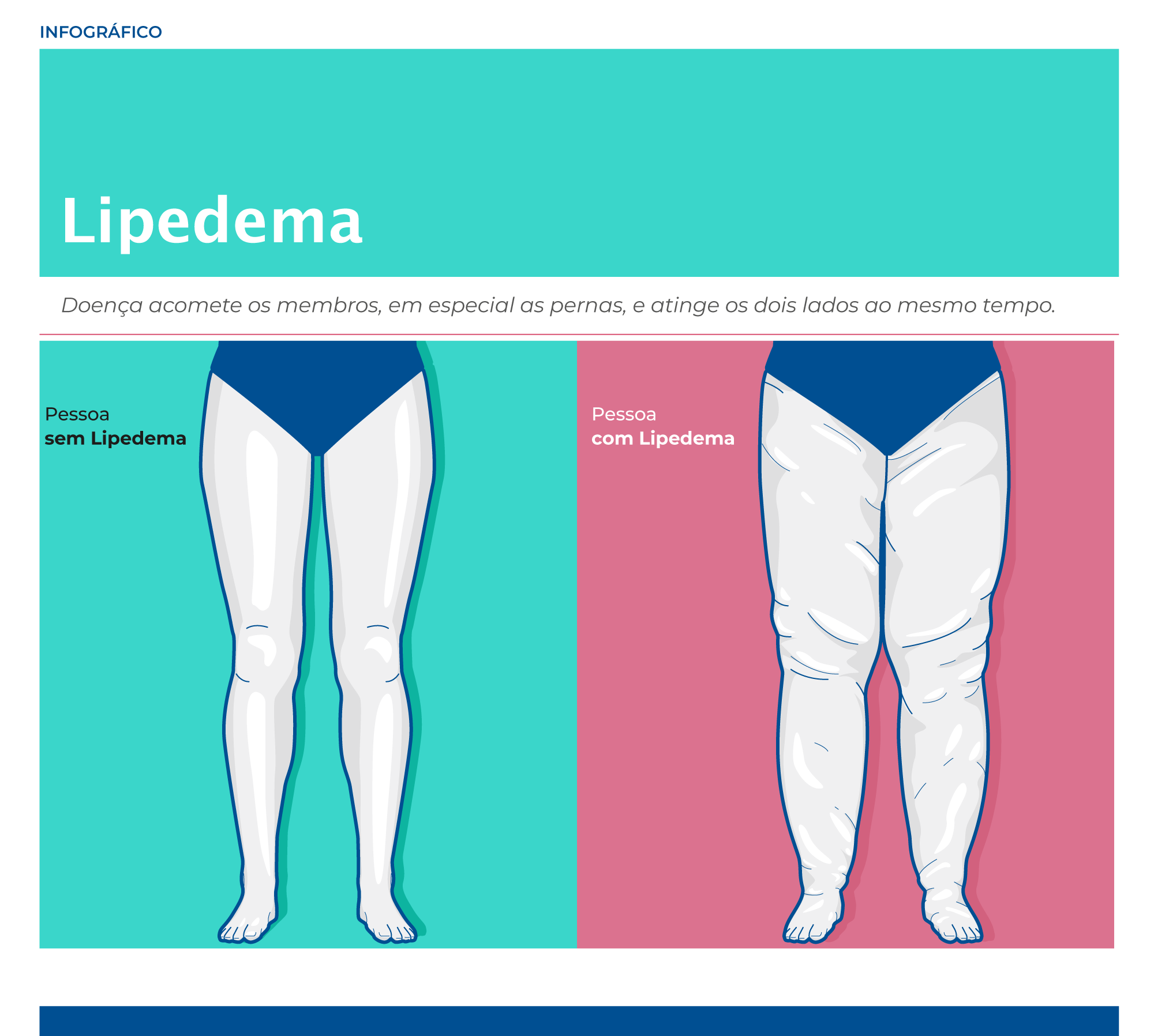 Lipedema: veja como identificar a doença e os tipos de tratamento